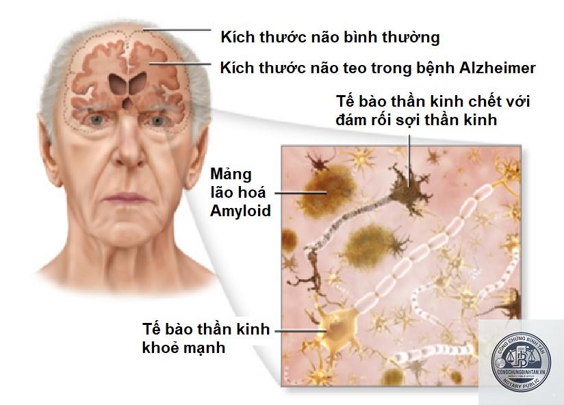 di ch&uacute;c của người bị alzheimer - H&igrave;nh 3