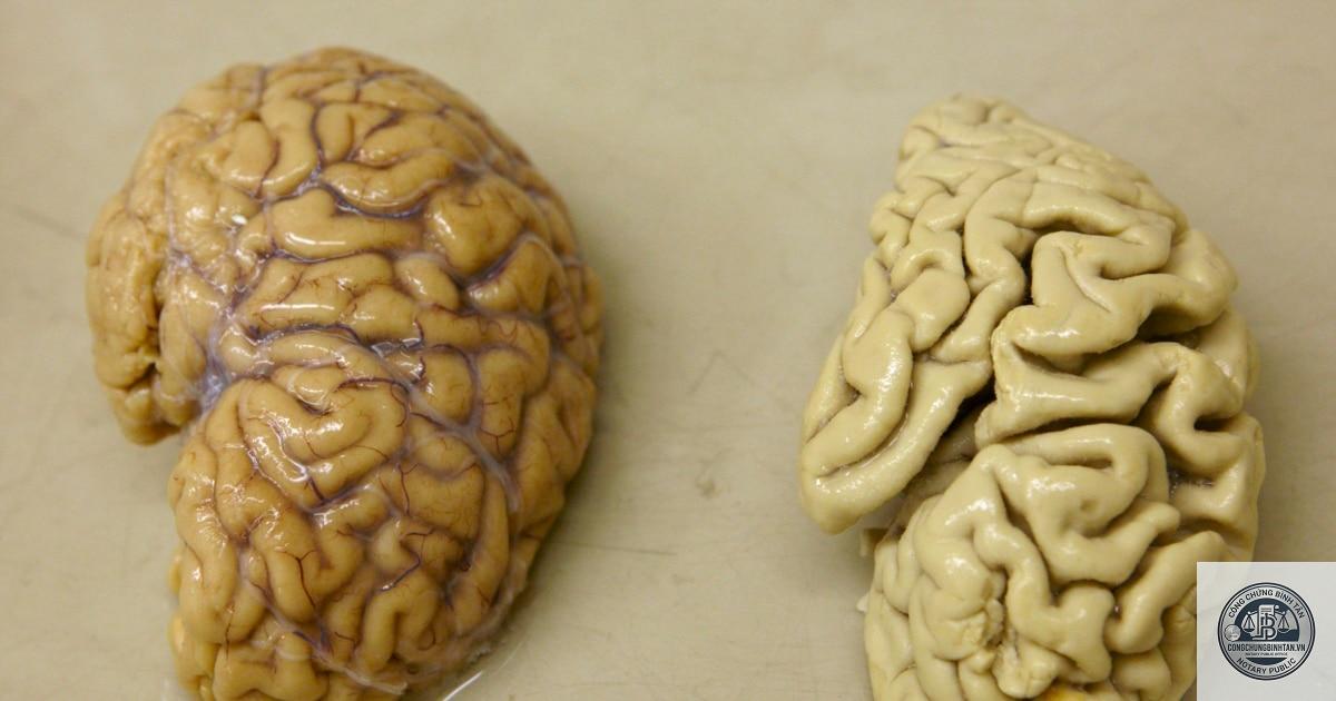 di ch&uacute;c của người bị alzheimer - H&igrave;nh 5